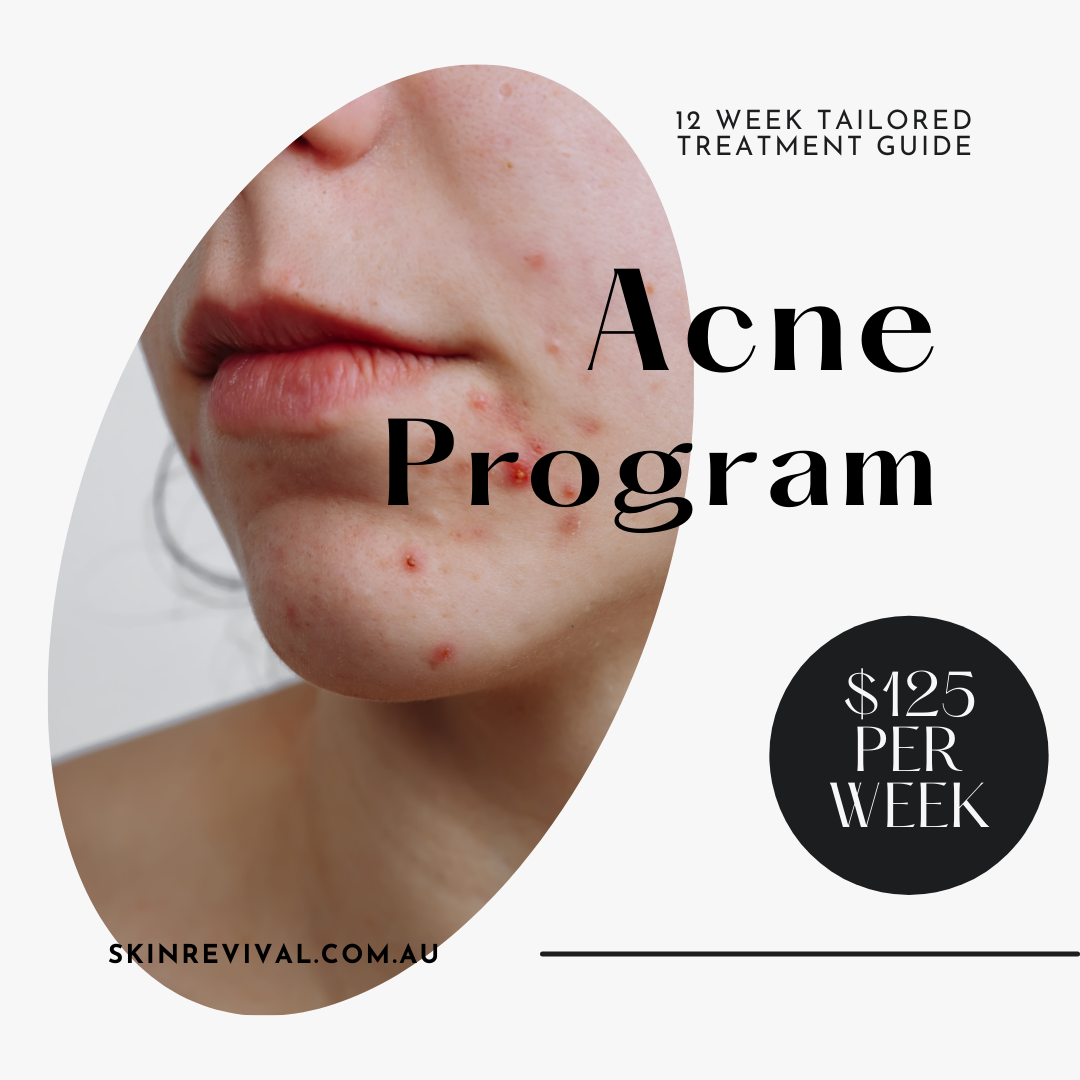 12 Week Acne Program