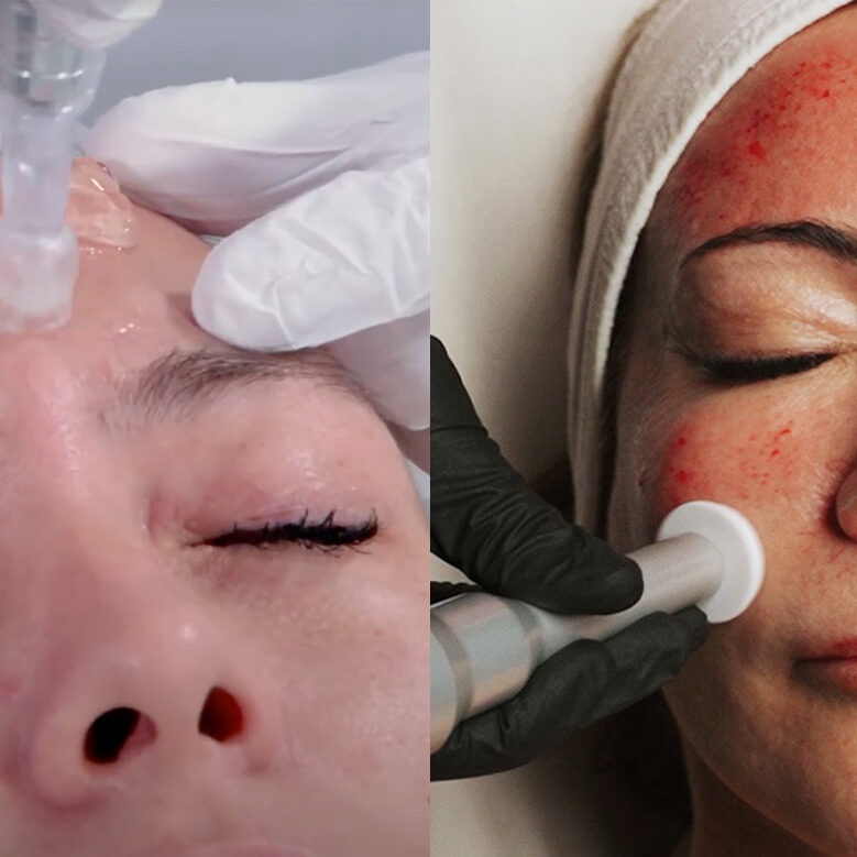 Wollongong’s Best Clinic for Microneedling and Microchanneling: What’s the difference?