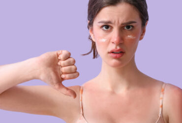 Don’t Let Sun Damage Hold You Back