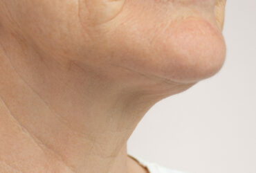 Let’s Talk About Skin Laxity