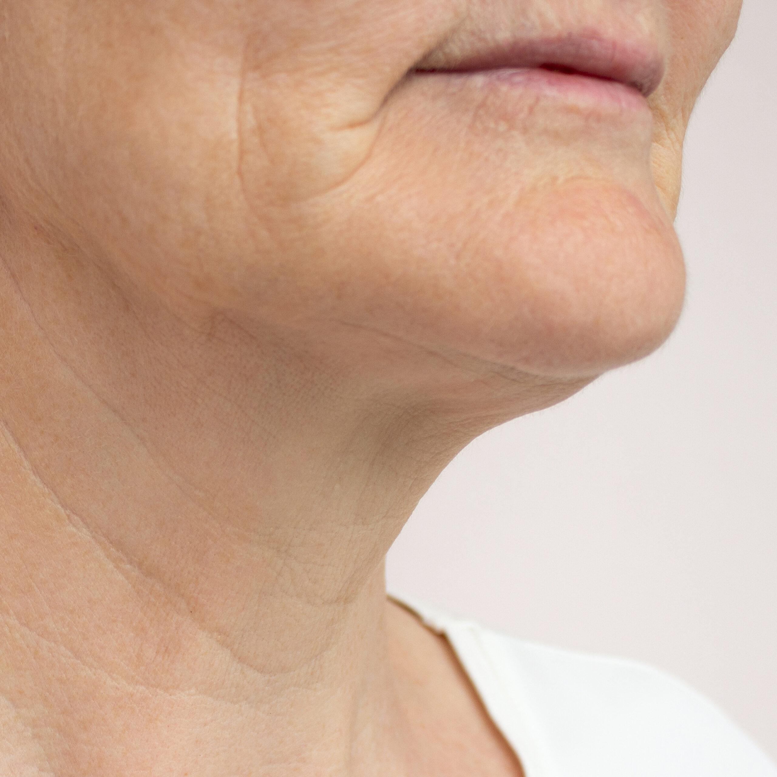 Let’s Talk About Skin Laxity