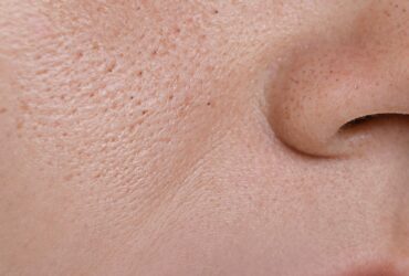 Understanding Enlarged Pores — From Cause to Correction