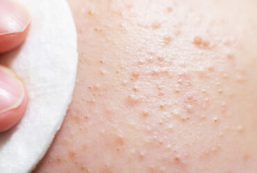 Breakouts Begin Beneath the Surface