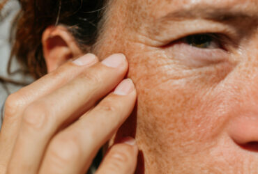 Summer is fun! Pigmentation? Not so much.