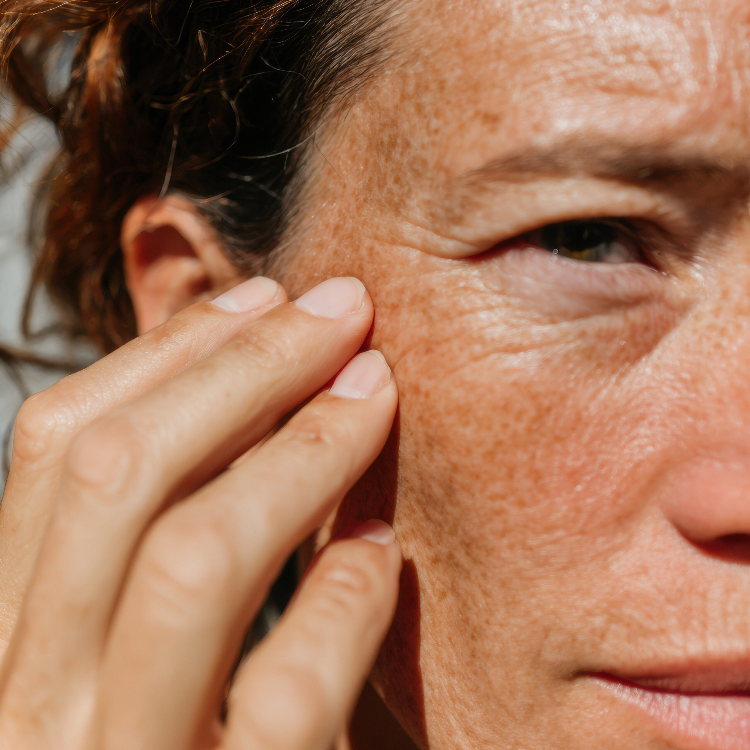 Summer is fun! Pigmentation? Not so much.