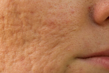 From Breakouts to Clearer Skin: Treating Acne Scars and Marks