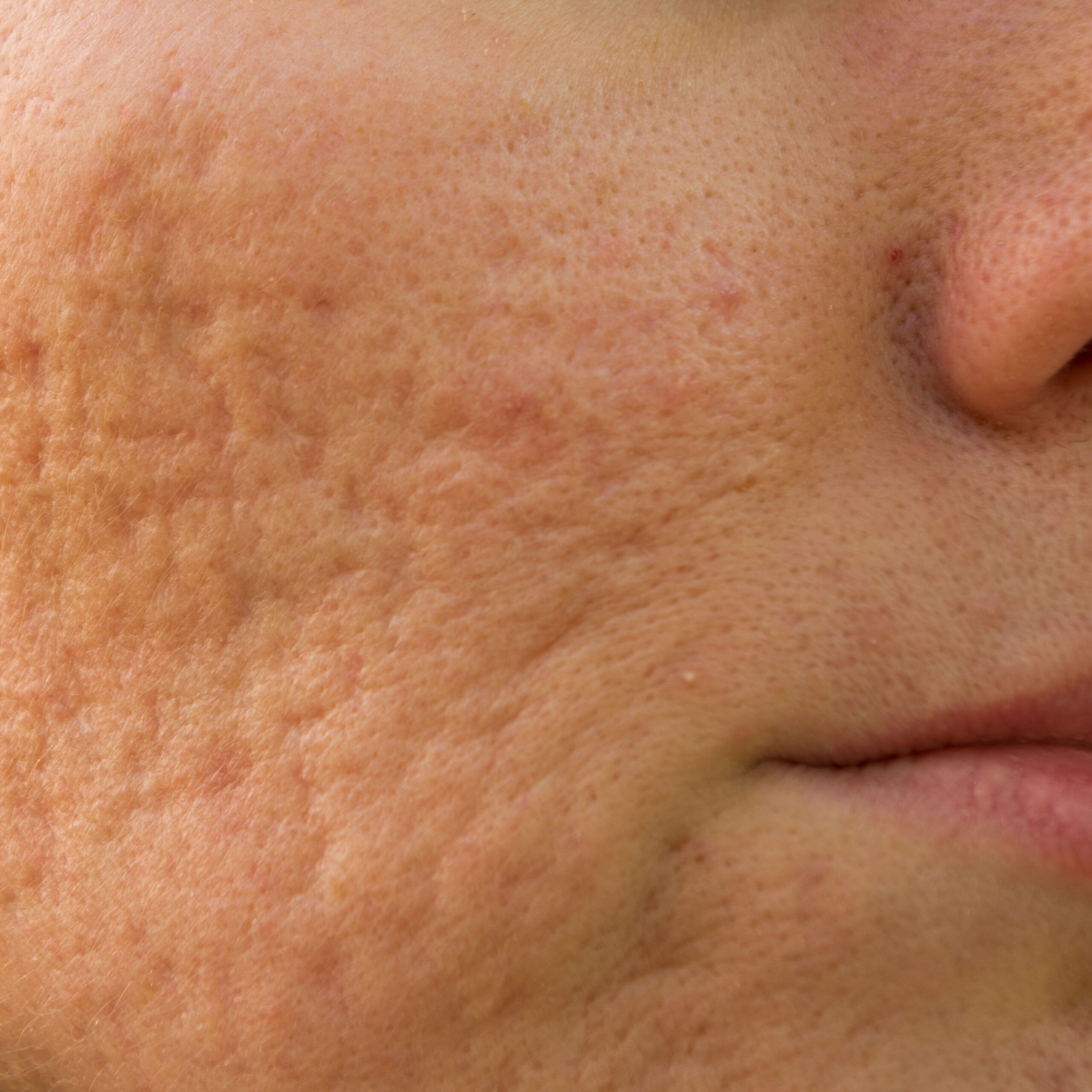 From Breakouts to Clearer Skin: Treating Acne Scars and Marks