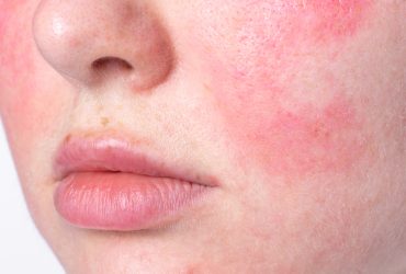 Redness, Flushing & Sensitivity: A Guide to Rosacea
