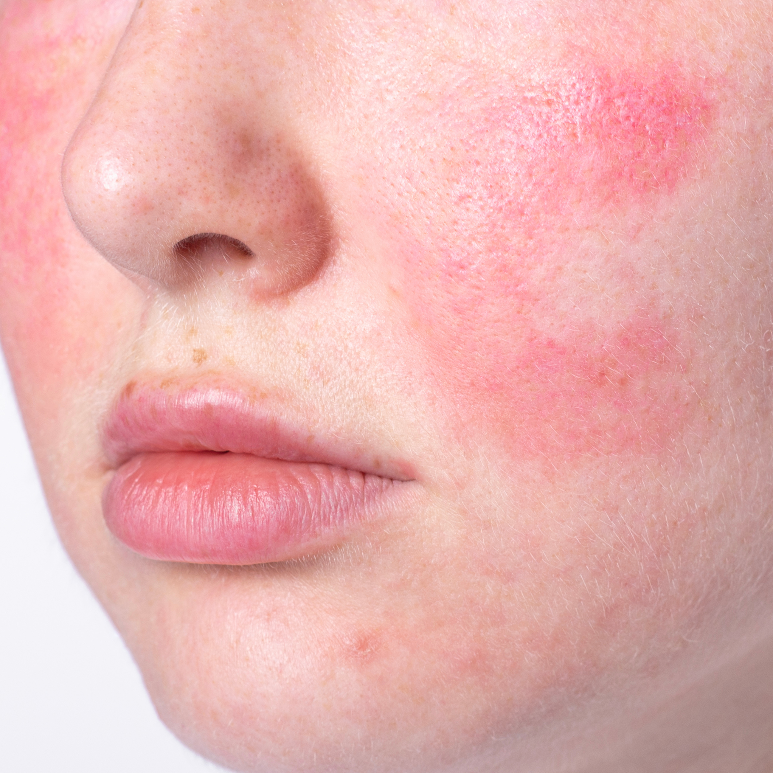 Redness, Flushing & Sensitivity: A Guide to Rosacea