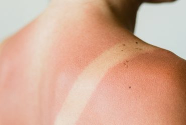 Predicted Intense Summer Conditions: Is Your Skin Ready?