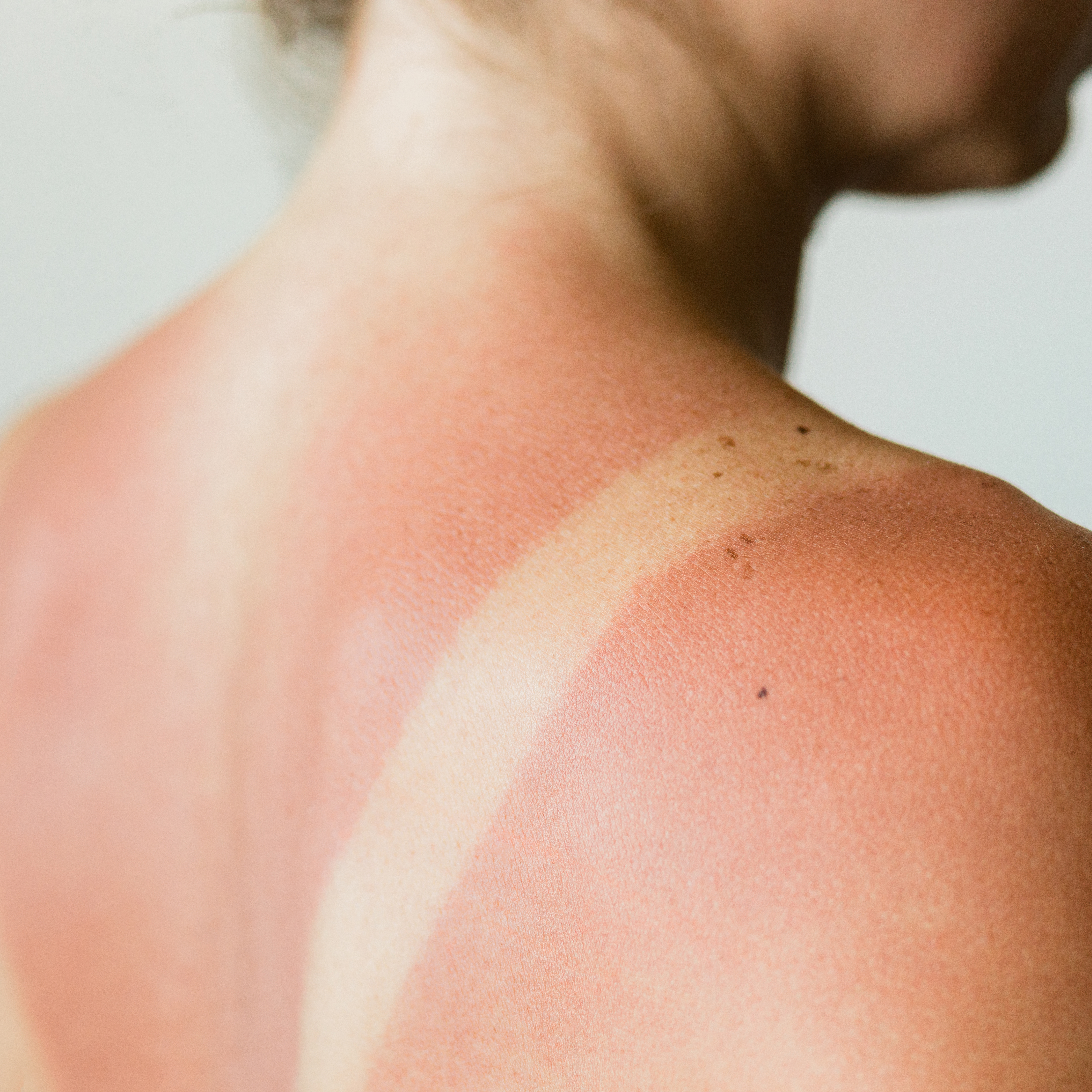 Predicted Intense Summer Conditions: Is Your Skin Ready?