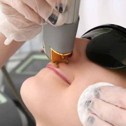 Laser hair removal in the beauty salon. Woman having facial hair removal. Laser hair removal equipment in the background.